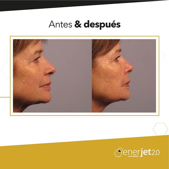 Antes y después 1